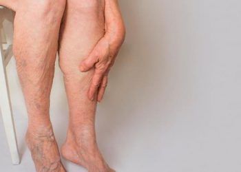 Cuatro síntomas que te alertan de un trombo