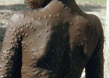 OMS considera innecesario vacunar masivamente contra viruela del mono