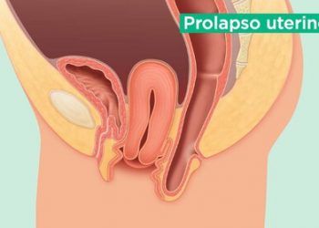 Nuevo y certero modelo de diagnóstico para prolapso uterino