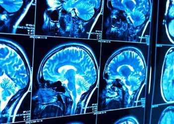 Resonancias permiten ver inflamación del cerebro “En Vivo”