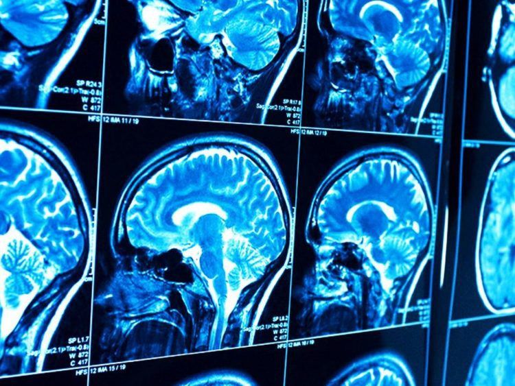 Resonancias permiten ver inflamación del cerebro “En Vivo”