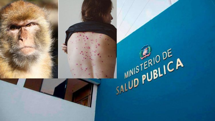 Salud Pública confirmará hoy caso sospechoso viruela del mono 