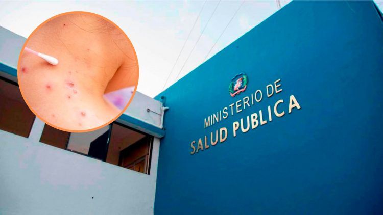 Salud Pública anuncia nuevos casos de viruela del mono en RD 