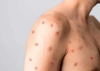 Puerto Rico suma 50 casos de viruela del mono