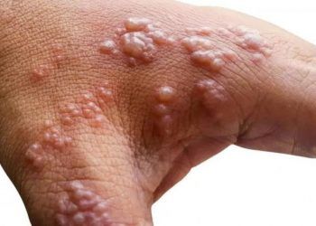 Salud Pública confirma dos nuevos casos de viruela del mono en el país