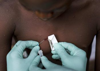 MSP localiza haitiano que dio positivo a viruela del mono en San José de Ocoa