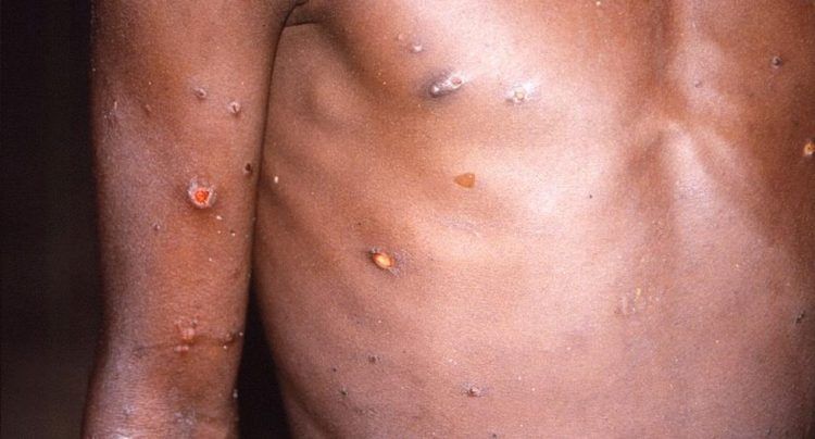 RD contabiliza unos 15 casos de Viruela del Mono