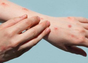 OMS declara la viruela del mono como una emergencia internacional de salud pública