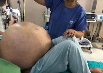 Extirpan un tumor de más de 50 kilos del abdomen de una mujer en Italia