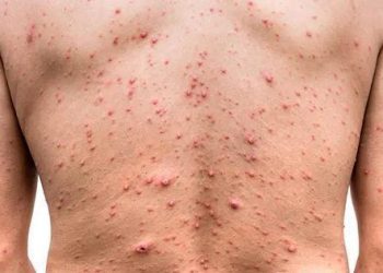 Emiten alerta epidemiológica por brote de viruela del mono en otros países