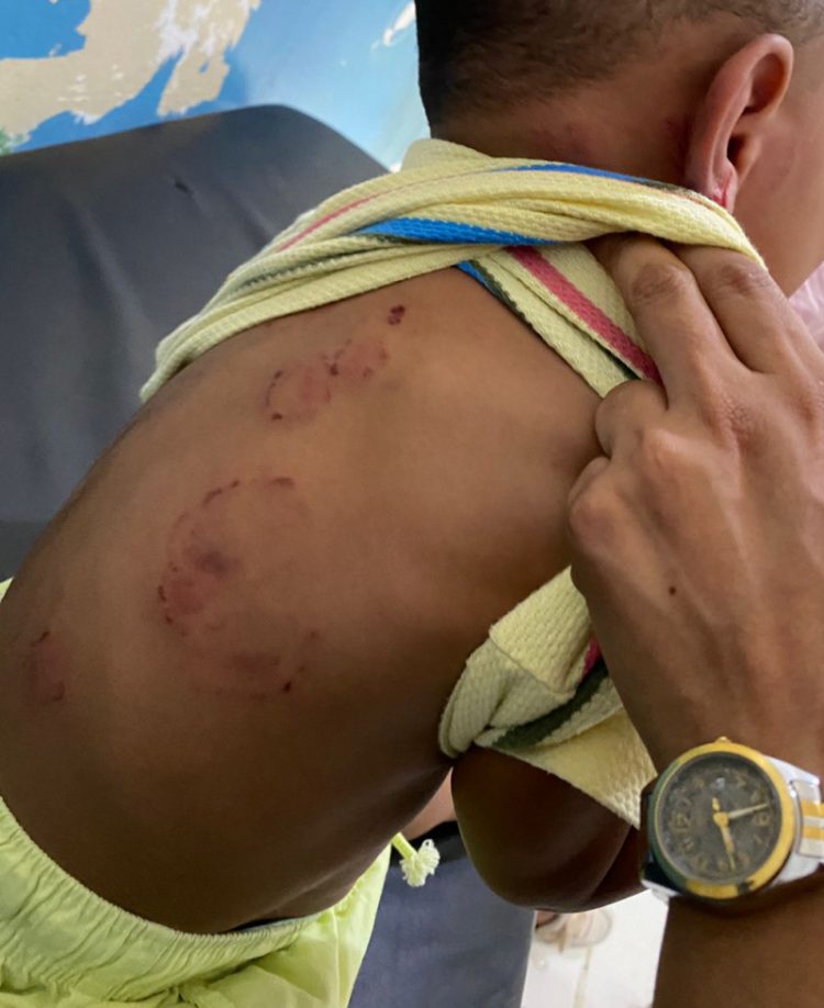 Niño agredido y mordido brutalmente en el Caipi, Santiago