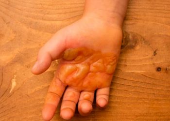 Mujer quema las manos de su hijo de tres años en La Vega