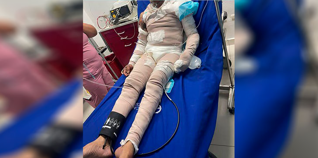 Hombre pierde la vida tras ser quemado por su pareja en Higüey